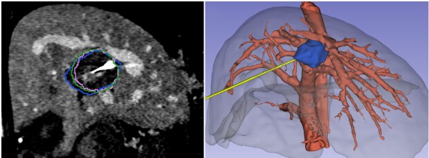 Coupe scanner d'un foie et arbre vasculaire avec l'aiguille